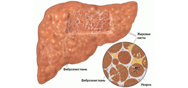Фиброз печени 3 степени фото