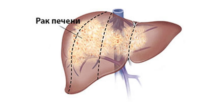 Лечение гепатита B уменьшает риск развития рака печени
