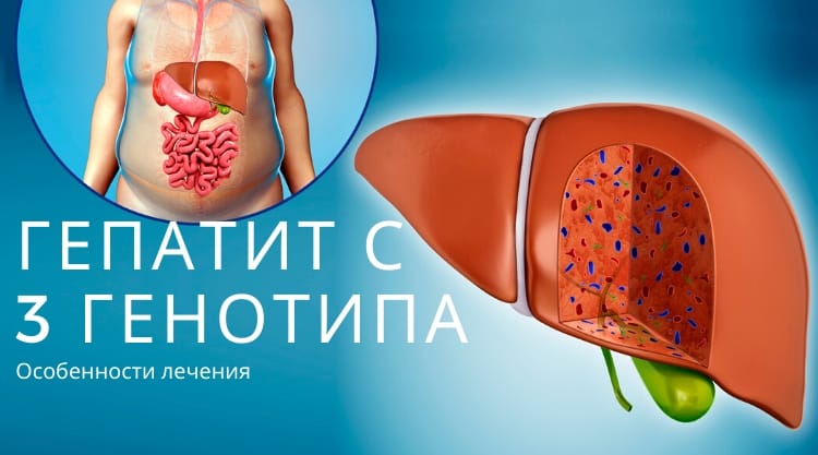 Гепатит С генотип 3 : лечение Софосбувир + Даклатасвир
