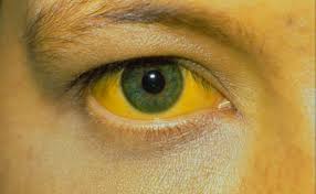 Желтушность кожи и белков глаз
