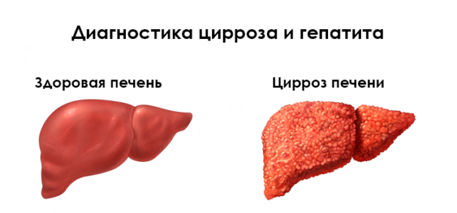 Печень 1 или 2. Хронический гепатит и цирроз печени.