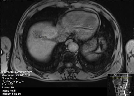Магнитно-резонансный снимок пациента 2. Характер T1 наводит на мысль о гепатоцеллюлярной карциноме.