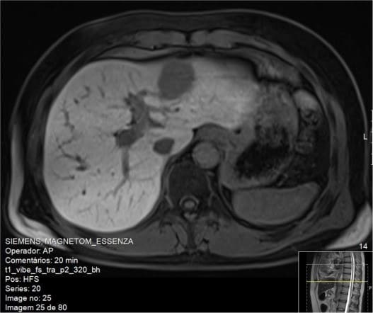 Магнитно-резонансный снимок пациента проведен с контрастом. Узелковый характер T1 наводит на мысль об аденоме печени.