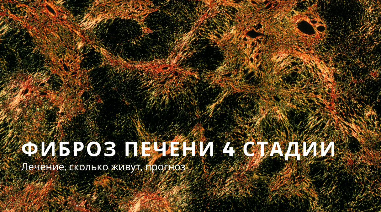 Печень 4 стадии. Фиброз печени 4 степени. Степени фиброза печени. Фиброз печени 4 степени гепатит с.