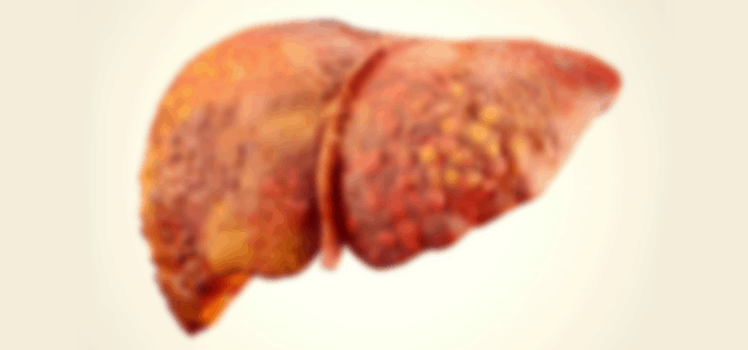 Можно ли вылечить фиброз печени 3 степени при гепатите с thumbnail