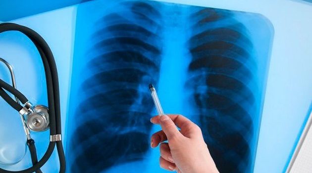 В семи регионах РФ выросла смертность от туберкулеза