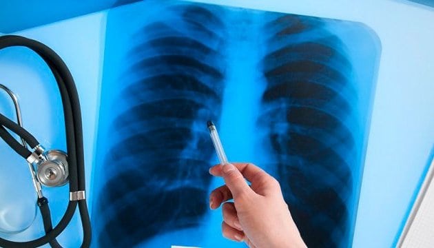 В семи регионах РФ выросла смертность от туберкулеза