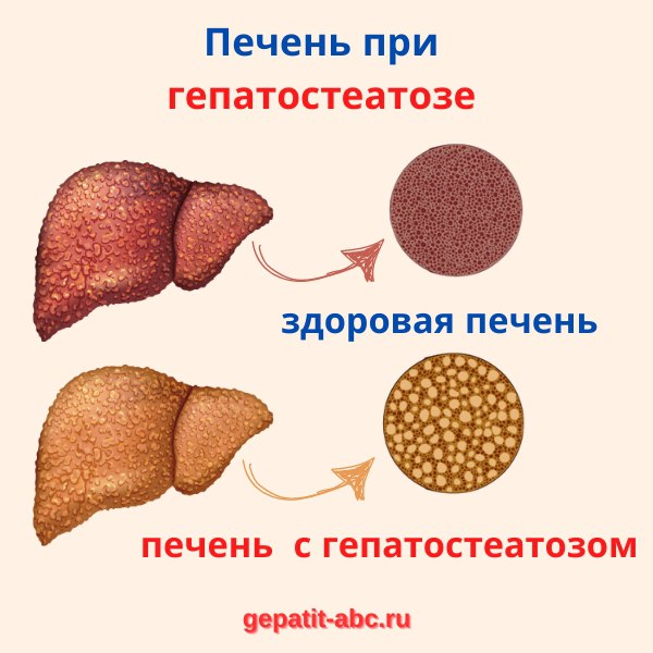 Гепатостеатоз